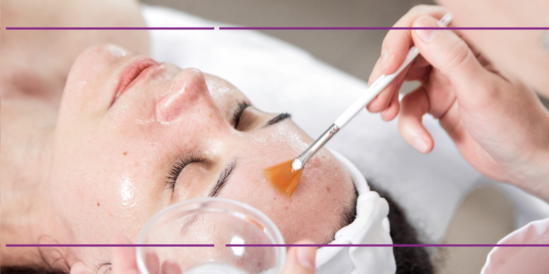 The Benefits and Uses of Trichloroacetic Acid (TCA) Peels in Aesthetic Medicine